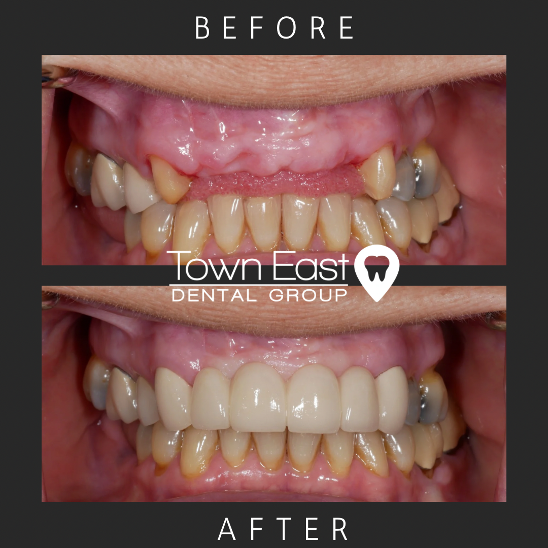 Bridge dental case before and after photo