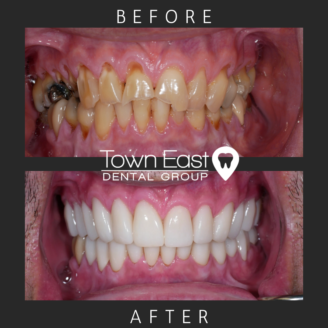 smile makeover case- before and after photo