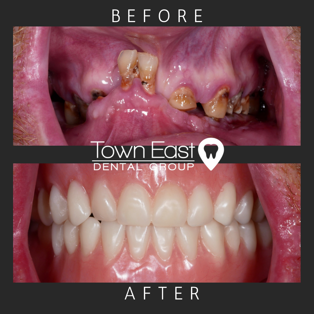 dentures case, before and after photo