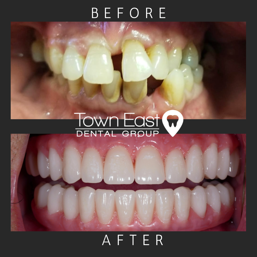dental implant before and after photo