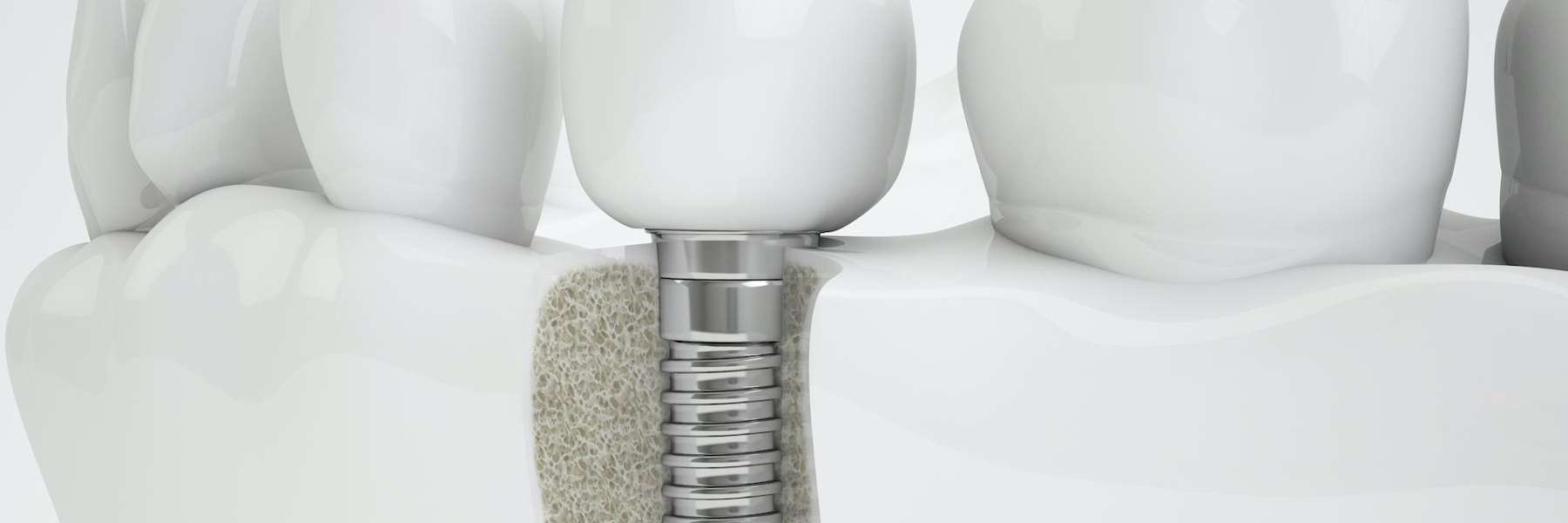 dental implant screw Mesquite TX