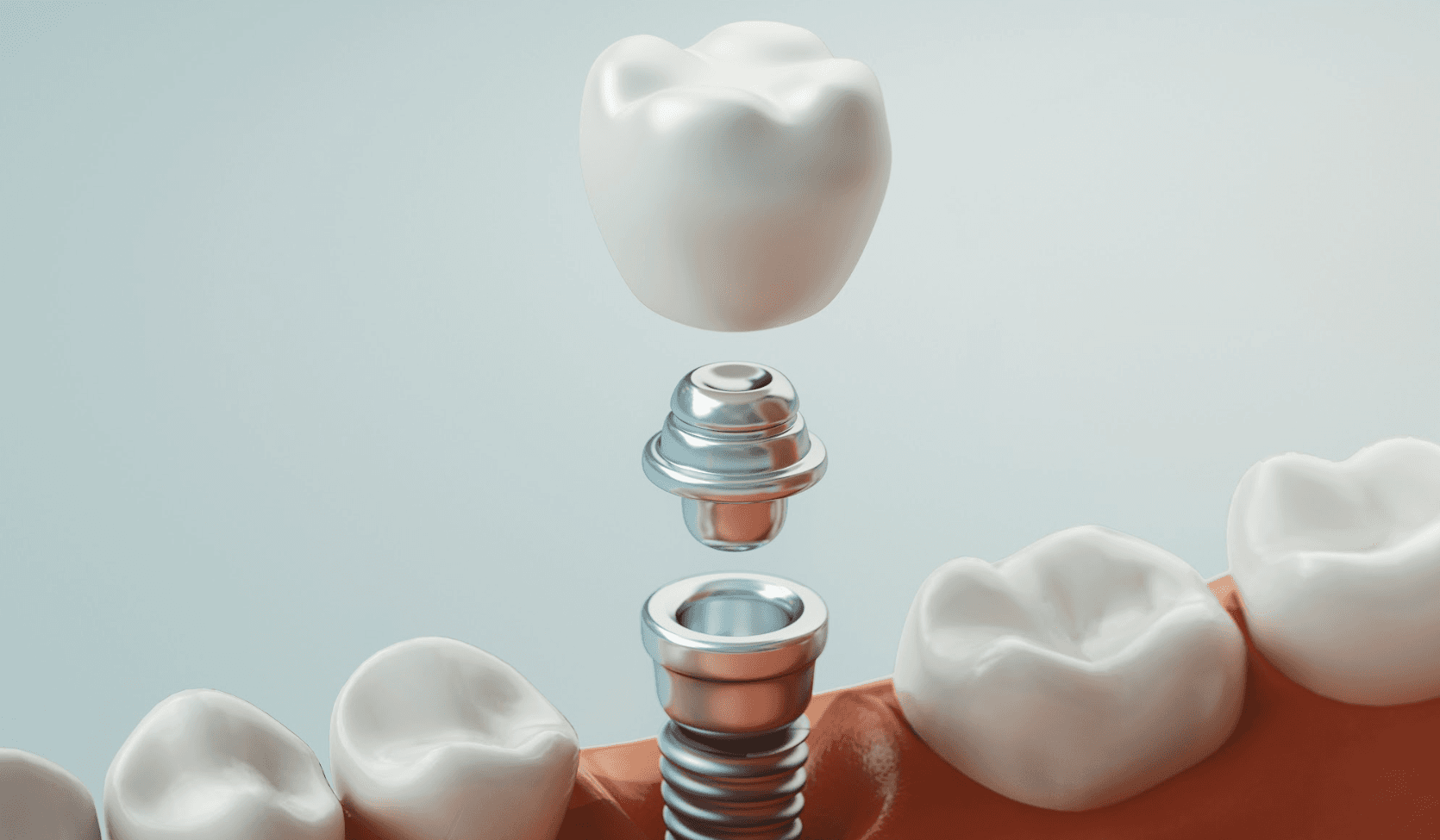Candidates for Dental Implants