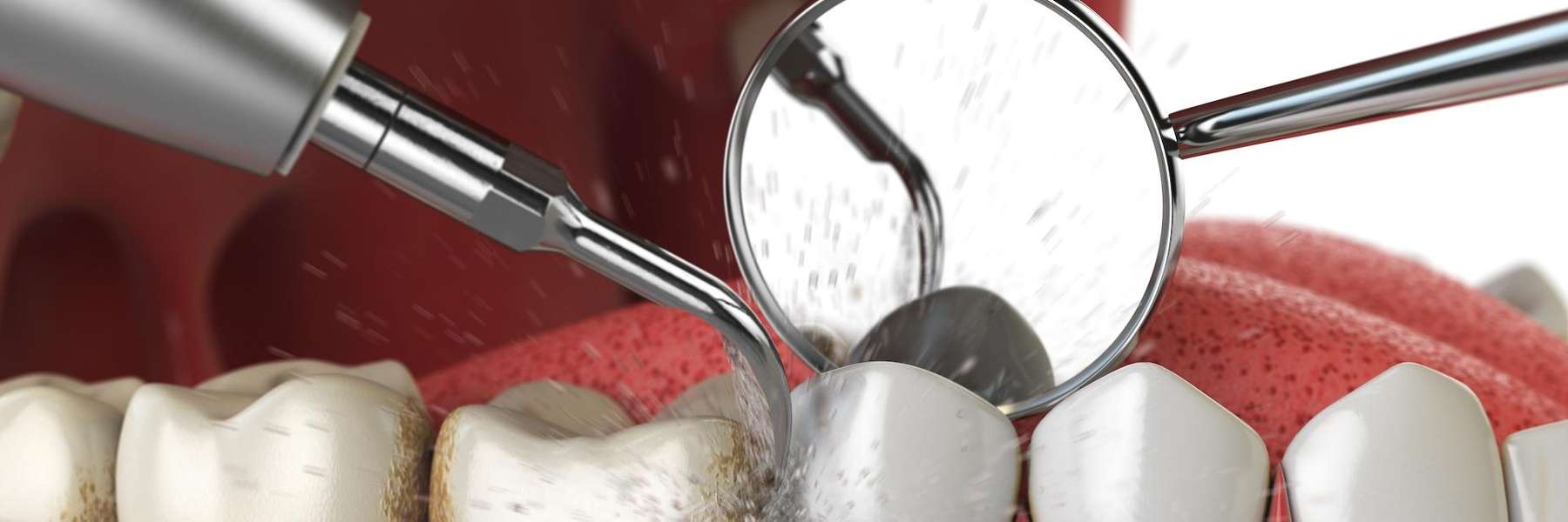 dental cleaning in Mesquite, TX