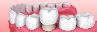 3D rendering of dental crowns | dentist in mesquite tx