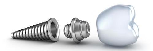 dental implant illustration in Mesquite, TX