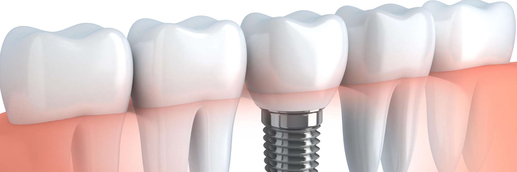 Dental Implant Illustration in Mesquite, TX