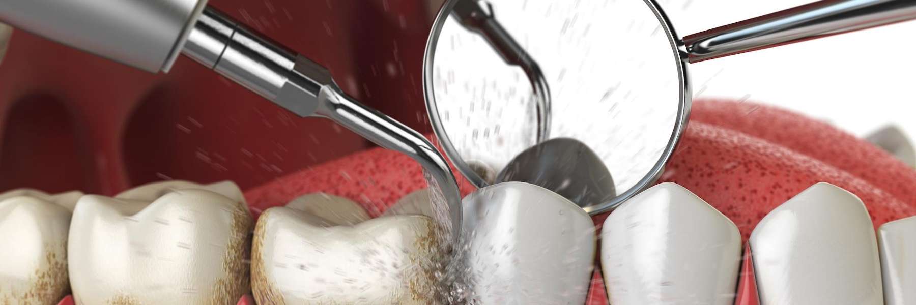 dental cleaning mesquite tx