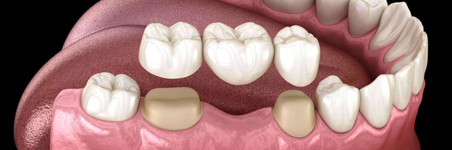 dental bridge illustration