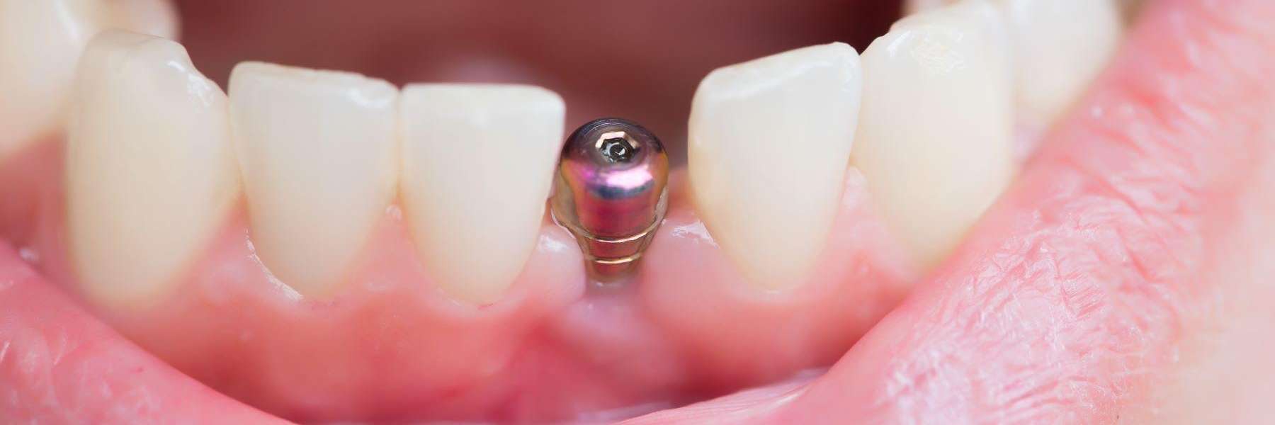 dental implants mesquite tx