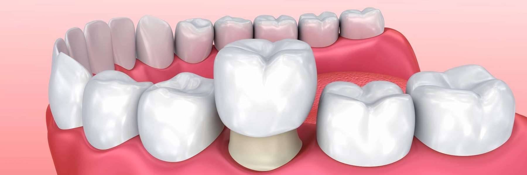 dental crown illustration