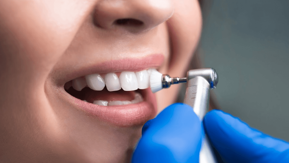 Different Types of Dental Cleanings? Dentist Mesquite TX