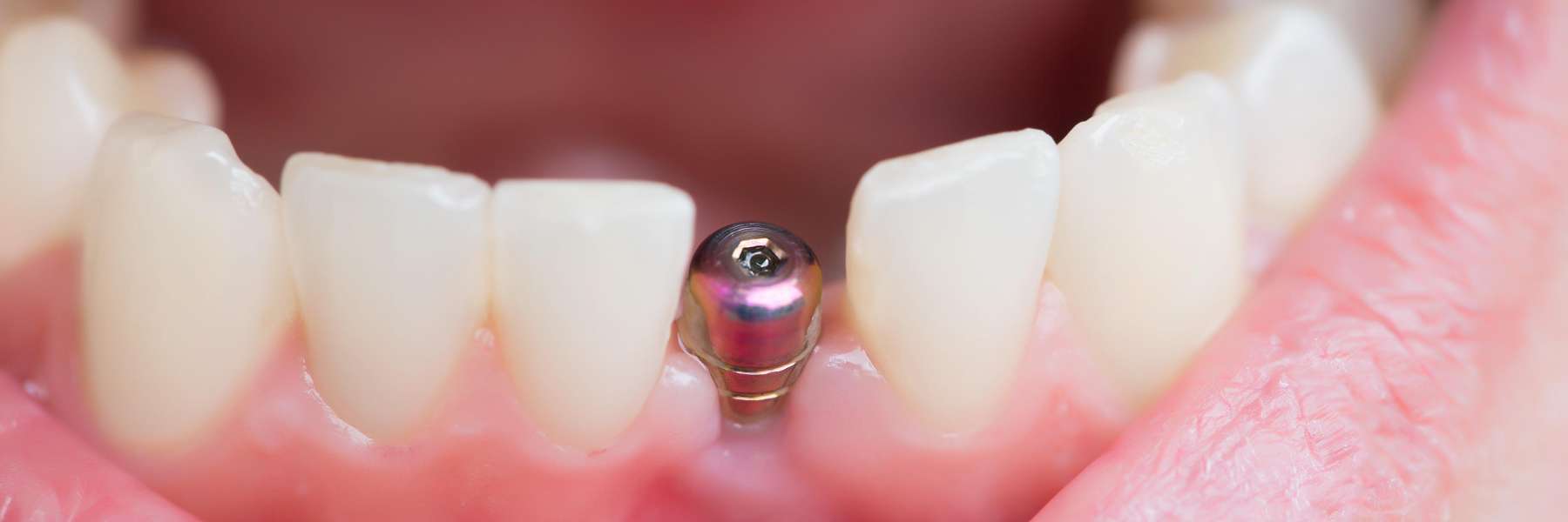 dental implants mesquite tx