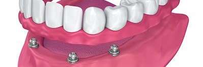 Implant Supported Dentures in Town East Dental Group
