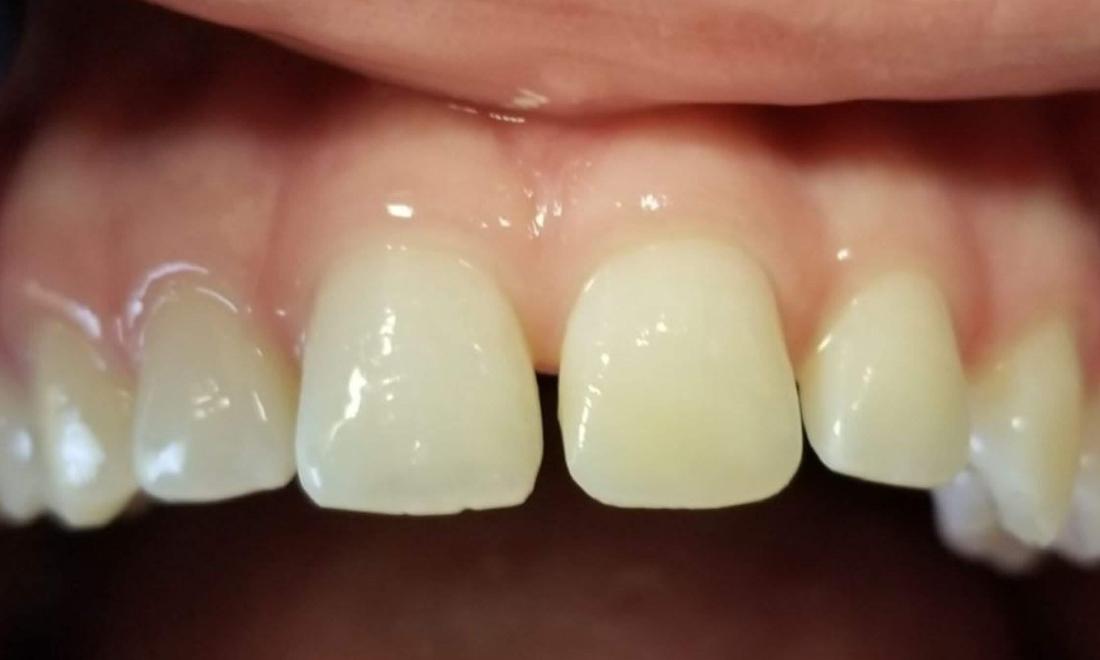 Town East Dental Group's Smile Gallery Chipped front tooth