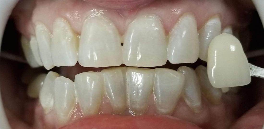 After Teeth Whitening in Mesquite, TX