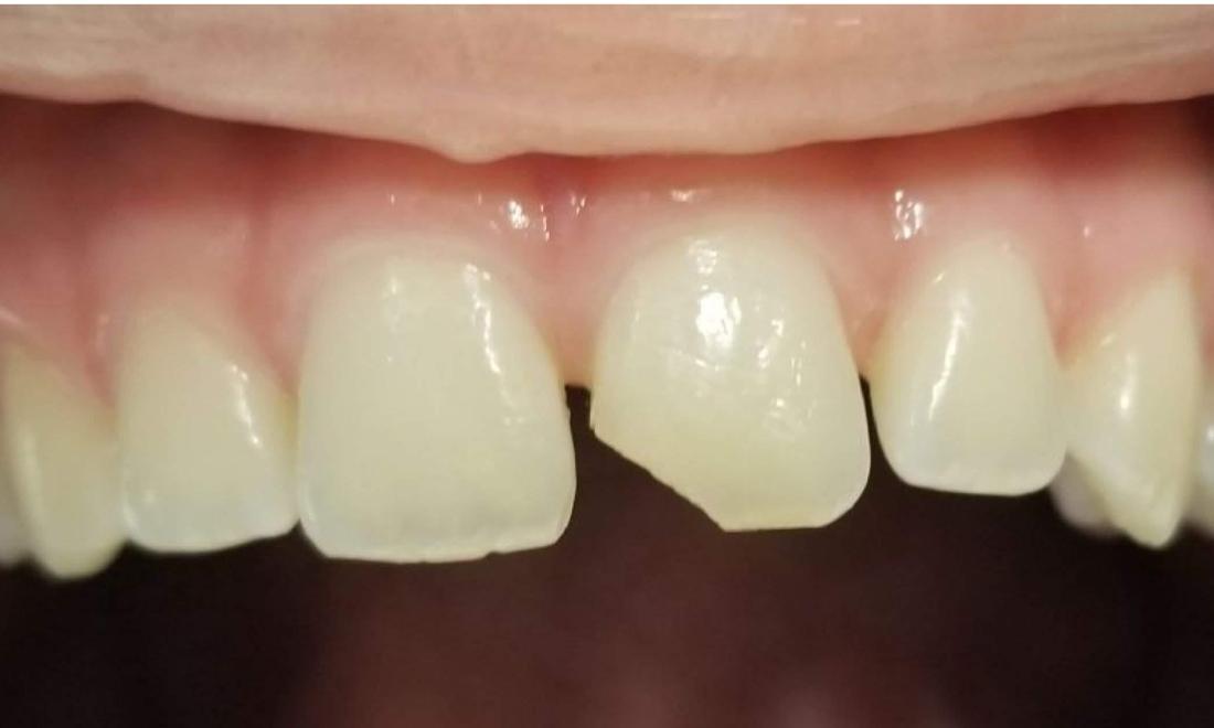 front chipped tooth | mesquite dental