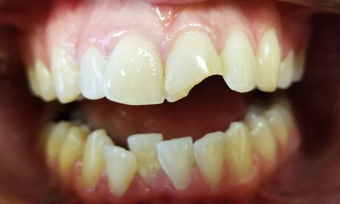 chipped front tooth close up | dentist mesquite tx