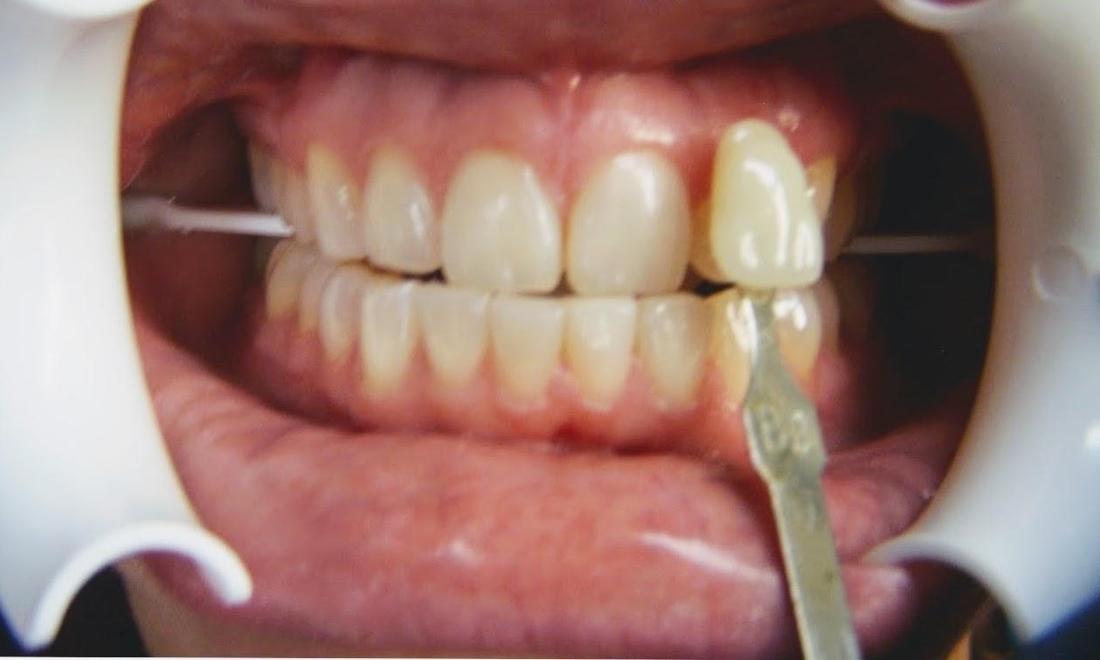 Before In Office Teeth Whitening in Mesquite, TX