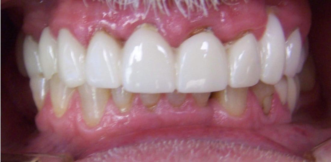 Before upper and lower crowns in Town East Dental Group