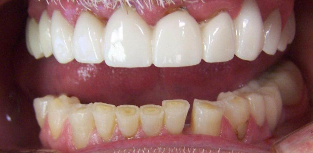 Before upper and lower crowns in Mesquite, TX