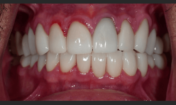 smile makeover dental case- after photo