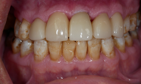 dental crowns and implants- after photo