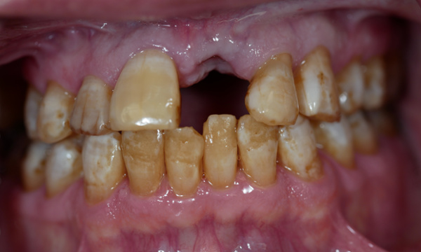dental crowns and implants- before photo