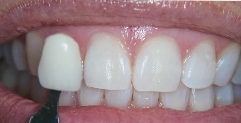 In-Office-Teeth-Whitening-After-Image