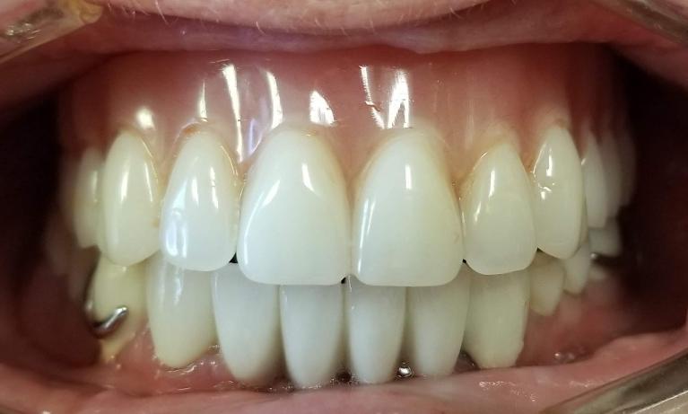 Bridges-crowns-and-partials-After-Image