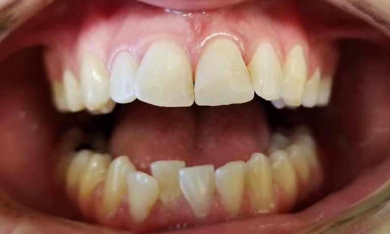 Repair-Chipped-Teeth-After-Image