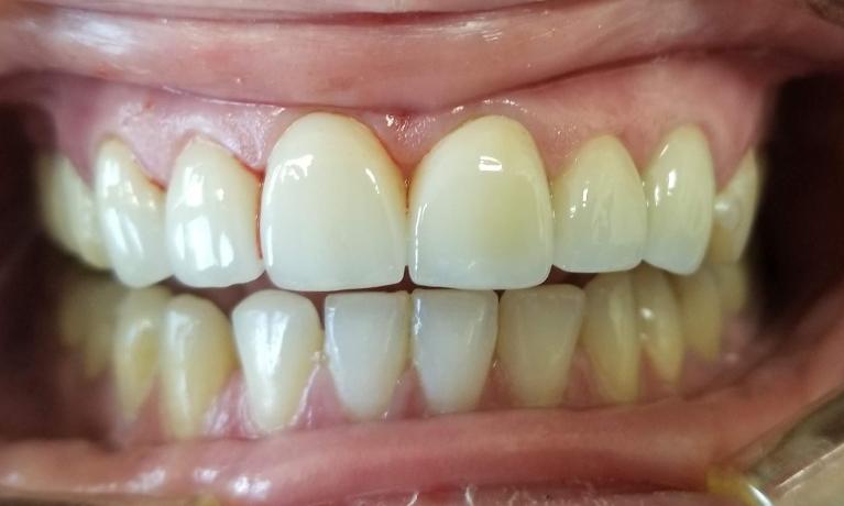 Front-crowns-After-Image