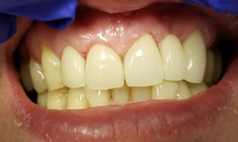 restored smile after dental crowns and bridges | dental bridges mesquite tx