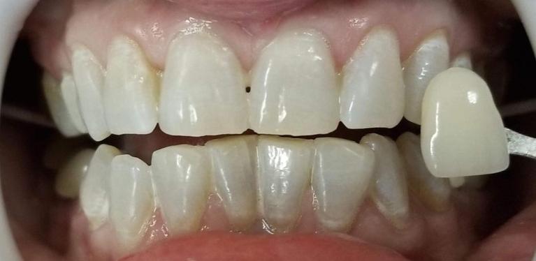 Teeth-Whitening-After-Image
