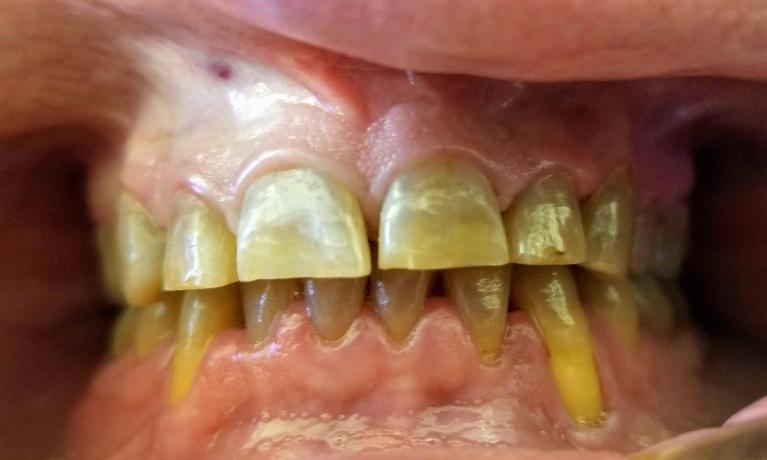 After Tooth-colored fillings in Mesquite, TX