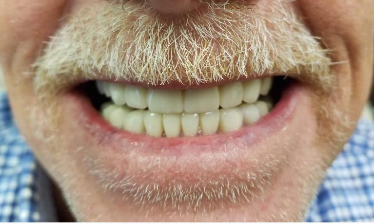 After upper and lower crowns in Town East Dental Group