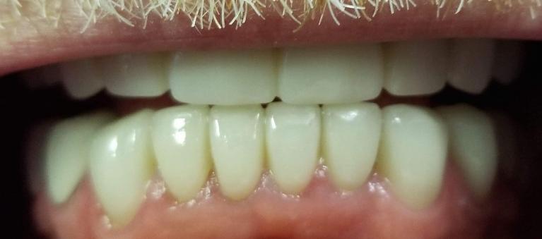 After upper and lower crowns in Mesquite, TX