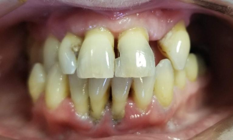 Bridges-crowns-and-partials-Before-Image