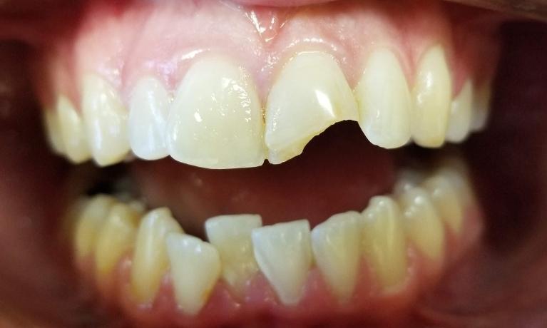 Repair-Chipped-Teeth-Before-Image