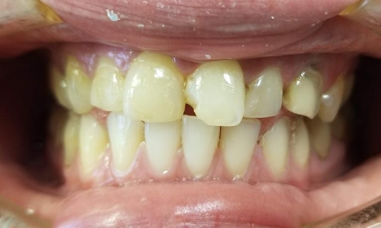 Front-crowns-Before-Image