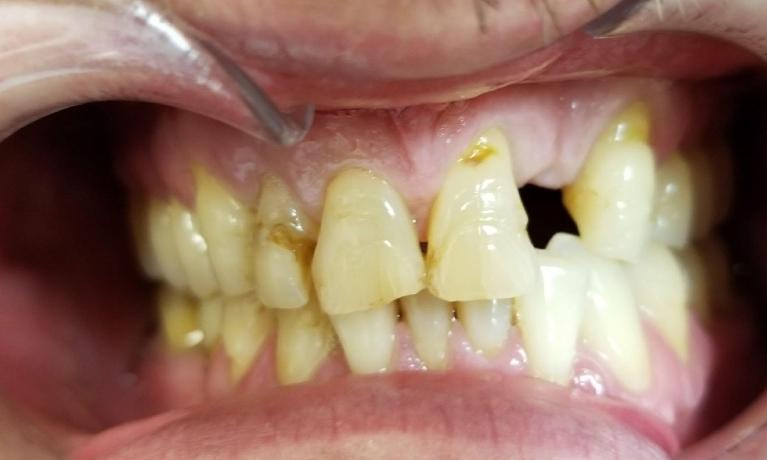 close up of missing teeth | dentist in mesquite tx