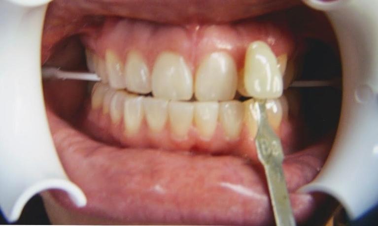 In-Office-Teeth-Whitening-Before-Image