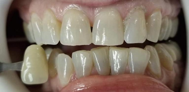 Teeth-Whitening-Before-Image