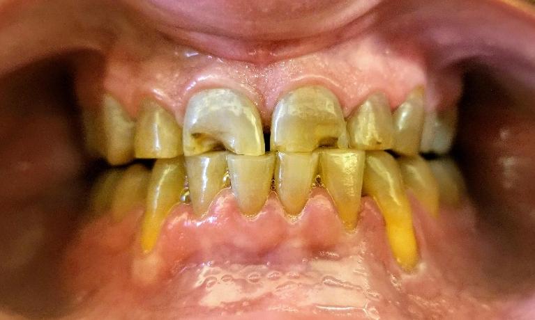 Before Tooth-colored fillings in Mesquite, TX