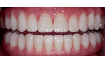 After treatment - All-on-4 Smile Makeover