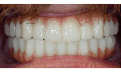 After treatment - All-on-4 Smile Makeover