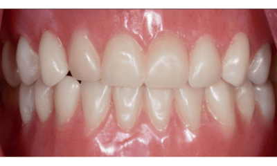 After treatment - Complete Denture Restoration