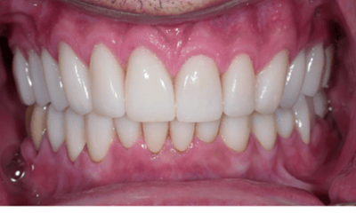 After treatment - Complete Smile Makeover