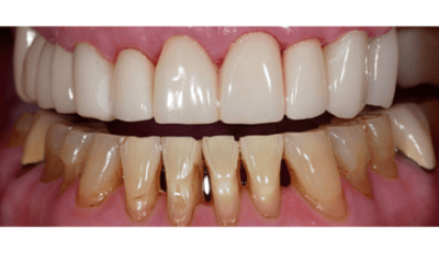 After treatment - Complete Smile Restoration