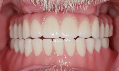 After treatment - Full-Mouth Implant Smile Makeover