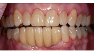 After treatment - Lower Implant Bridge Restoration